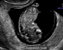 Holoprosencephaly, 11-12 weeks image