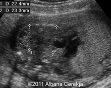 Multicystic dysplastic kidneys, bilateral image