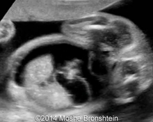 Transient idiopathic fetal ascites image