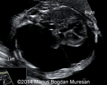 Successful thoracoamniotic shunting for isolated fetal pleural effusion image