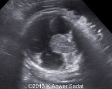 Alobar holoprosencephaly with proboscis and synophthalmia image