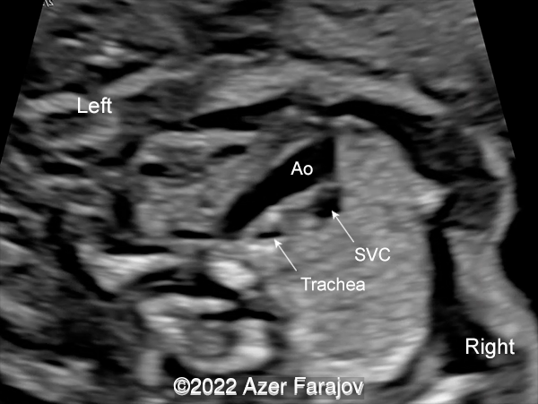 Transverse scan of the thorax at the level of the aortic arch. Ao - aorta; SVC - Superior Vena Cava