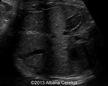 Fetal biliary sludge, 2 cases image