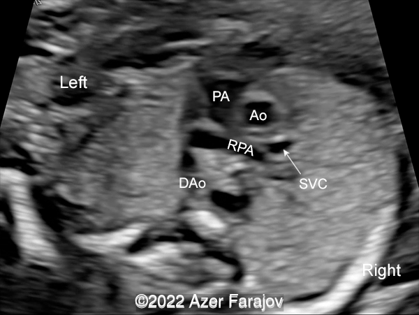 Three-vessel-trachea view of the heart showing pulmonary artery (PA), ascending aorta (Ao), superior vena cava (SVC), descending aorta (DAo), right pulmonary artery (RPA)