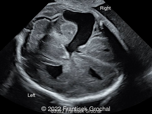 Transverse scan of the fetal head showing striking defect in cerebral mantle on the right side, filled with cerebrospinal fluid, connecting right lateral ventricle with meningeal surface – open-lip schizencephaly