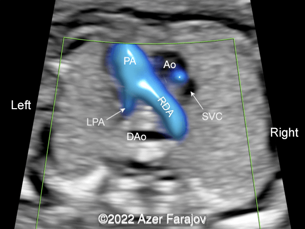 Color Doppler: three-vessel-trachea view - pulmonary artery (PA), RIGHT DUCTUS ARTERIOSUS (RDA) making a vascular ring around trachea and connecting to the descending aorta (DAo). Ascending aorta (Ao), superior vena cava (SVC).