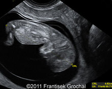 Trisomy 21 (Down syndrome), first trimester, two cases image