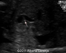 Fetal gallbladder: Phrygian cap deformity image