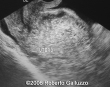 Abdominal pregnancy image