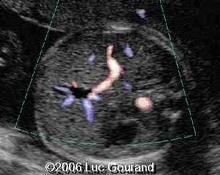 Gallbladder, non-visualization image