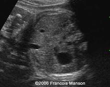 Gallbladder, hypoplasia image