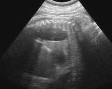 Diaphragmatic eventration image