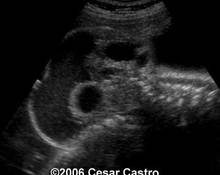 Sacrococcygeal teratoma, Type III image