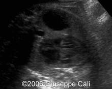 Diaphragmatic hernia, peritoneal pseudocyst image
