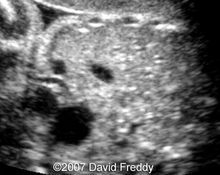 Umbilical vein varix image