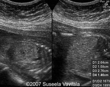 Infantile polycystic kidney disease, autosomal recessive image