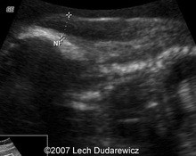 Trisomy 21, complete atrioventricular septal defect in the first and second trimester image