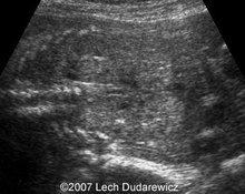 Autosomal recessive polycystic kidney disease image