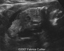 Limb body wall complex, 15 weeks of gestation image