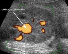 Umbilical vein varix image