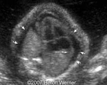 Trisomy 21, hydrops fetalis, and esophageal atresia image