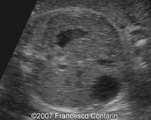 Liver cyst image