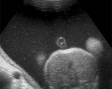 Esophageal atresia image