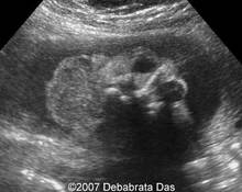 Iniencephaly image
