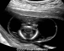 Iniencephaly and cystic hygroma image