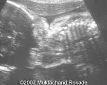Fetal goiter image