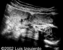 Abdominal pregnancy image