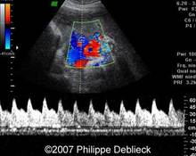 Notching in the umbilical artery Doppler waveform image