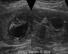 Urethral atresia image
