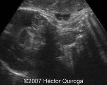 Fetal goiter image