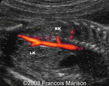 Ectopic left kidney with multiple renal arteries image