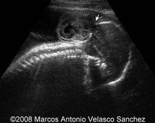 Cephalocele, occipital, 31 weeks image