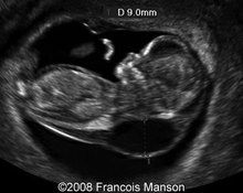 Cystic hygroma, monosomy X image