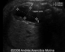 Primary vesicoureteral reflux and duplex kidney image