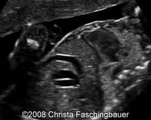 Gallbladder duplication image