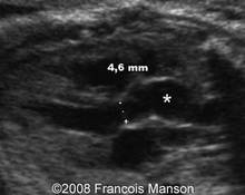 Bicuspid aortic valve image