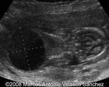 Urethral agenesis, 14 weeks image