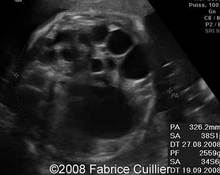 Multicystic dysplastic kidney disease, unilateral, 32 weeks image