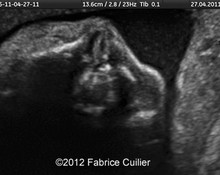 Unilateral cleft lip, cleft palate image