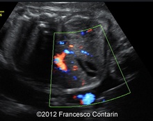 Gallbladder duplication image