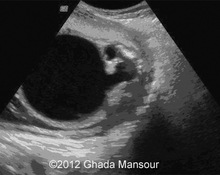 Posterior urethral valve image