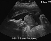 Congenital  epulis image