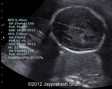Saccrococcygeal teratoma image