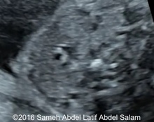 Fetal Goiter image