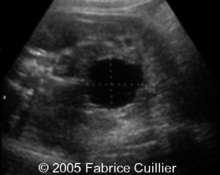 Posterior urethral valves, 32 weeks image