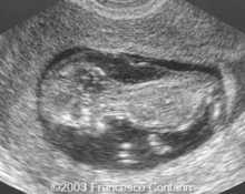 Trisomy 21, 12 weeks image